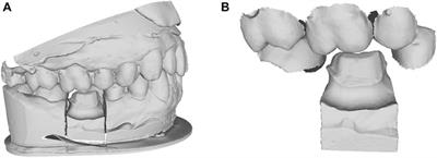 Frontiers | automated tooth crown design with optimized shape and